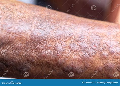 Atopic Dermatitis Ad Also Known As Atopic Eczema Is A Type Of