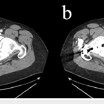 Axial Computerized Tomography CT Images Of Abdomen Pelvis With