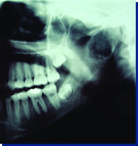 Panoramic Radiograph Demonstrated A Well Circumscribed Multilocular