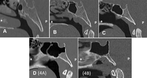 Types Of Sphenoid Sinus Pneumatization In Sagittal Plane A Conchal B Download Scientific