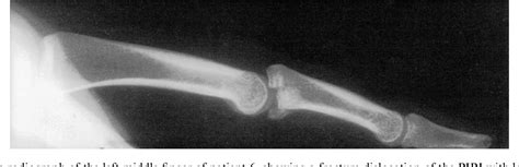 Figure From Internal Fixation Of Unstable Fracture Dislocations Of