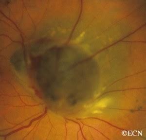 Choroidal melanoma of the optic nerve » New York Eye Cancer Center