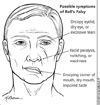 Facial Palsy (Bell ’s Palsy) | Rehab My Patient