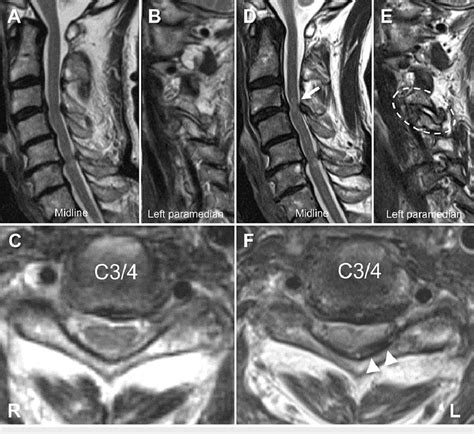 Preoperative T Weighted Magnetic Resonance Images Months A C And