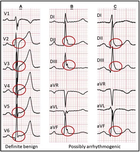 J Wave Syndromes Cardiac Electrophysiology Clinics