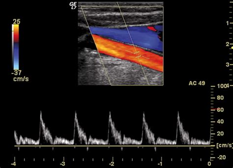 Ecodoppler Artero Venoso Arti Istituto Galeno