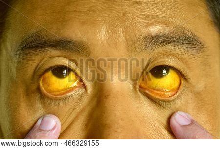 Deep Jaundice Asian Image Photo Free Trial Bigstock