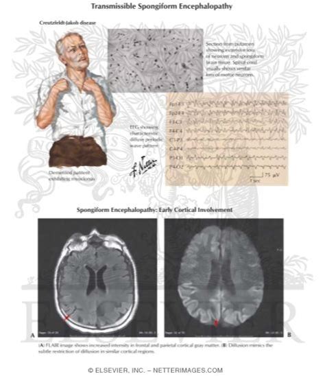 Transmissible Spongiform Encephalopathy