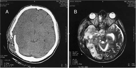 Traumatic Brain Injury Ct Scan