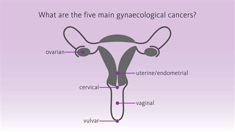 Gynaecological Cancer Awareness Detection Diagnosis And Treatment