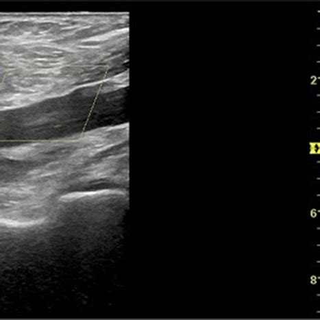 Color Doppler flow images revealing DVT involving the lower... | Download Scientific Diagram