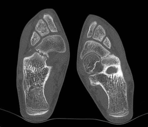 Tarsal coalition causes, symptoms, diagnosis & treatment