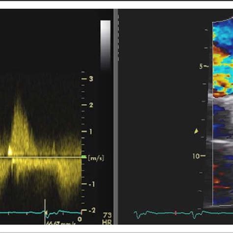 Left Continuous Wave Doppler At Right Ventricular Outflow Tract Download Scientific Diagram