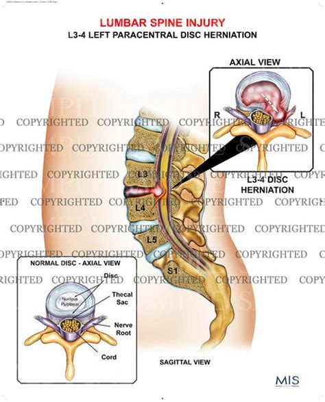 L3 4 Left Paracentral Disc Herniation — Medical Art Works