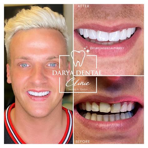 How Much Do Veneers Cost Darya Dental Clinic