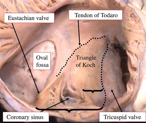 Triangle Of Koch Cardiac Anatomy Diagnostic Medical Sonography Basic Anatomy And Physiology