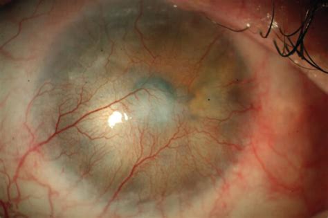 The Loss Of Limbal Stem Cells Results In Cornea Conjunctivalization A