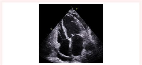 Patient S Initial Transthoracic Echocardiogram Showing Dilated