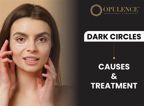 Dark Circles Causes And Treatment Opulence Dermatologist And Aesthetics