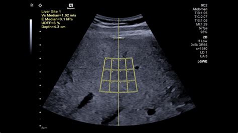 Liver Ultrasound Derived Fat Fraction Udff White Paper Siemens