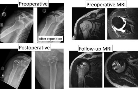 Rotator Cuff Tear Mri