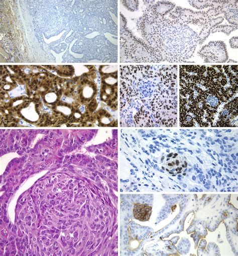 Cribriform Morular Variant Of Thyroid Carcinoma A Neoplasm With