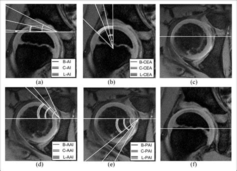 Figure 1 From Evaluation Of The Labrum On Postoperative Magnetic Resonance Images A Predictor