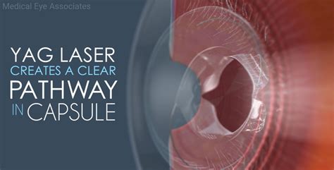 YAG Laser Capsulotomy Image 2 - Medical Eye Associates