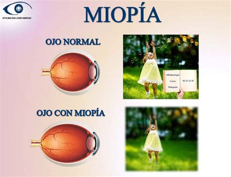 Miopia Que Es Causas Y Síntomas Clínica Oftalmología Láser Obispado