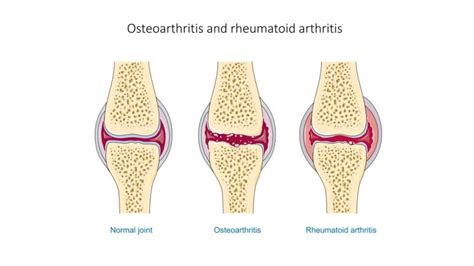 Figure Comparison Of Osteoarthritis And Rheumatoid Arthritis