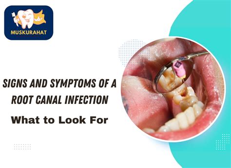 Signs And Symptoms Of A Root Canal Infection What To Look For