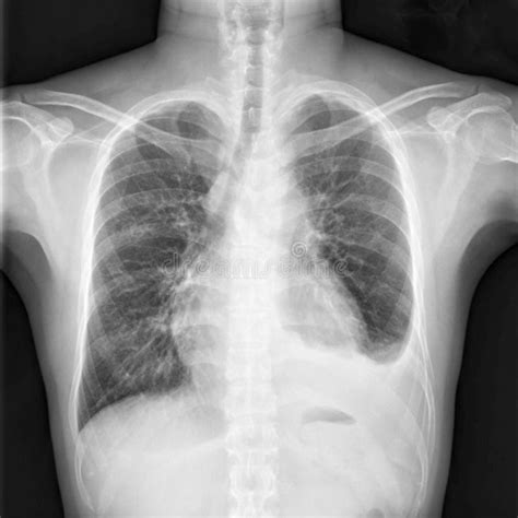 Chest X Ray Shows Cardiomegaly With Infiltration And Loculated Pleural