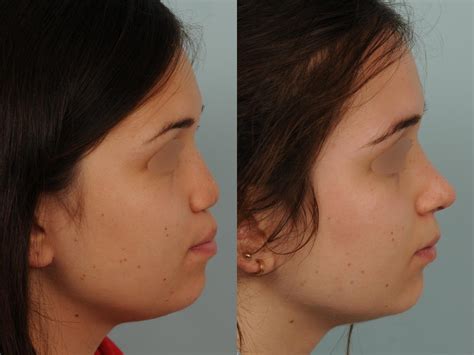 Rhinoplastie avant après photos et exemples de nez refaits