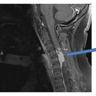 Sagittal T Weighted Preoperative Mri With Contrast Showing An Anterior