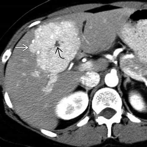 Focal Nodular Hyperplasia CT Scan