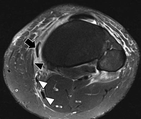 Stener Like Lesions Of The Superficial Medial Collateral Ligament Of