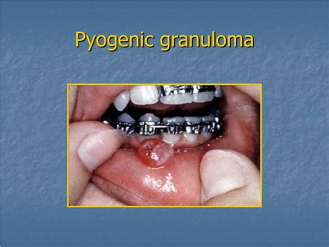 Ppt Diseases Of The Oral Cavity Powerpoint Presentation Free