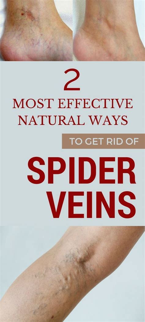 2 Most Effective Natural Ways To Get Rid Of Spider Veins All Beauty Tips For Women Get Rid