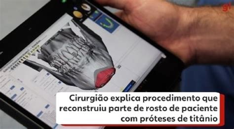 Titânio em cirurgias entenda como o metal ajudou na inédita