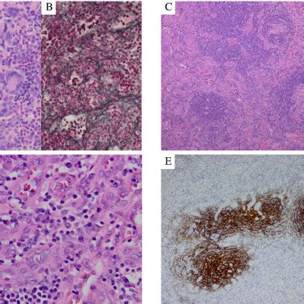 Clinical Features Of TAFRO Syndrome In Eight Previously Reported Cases