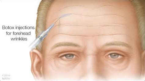 Demostrada La Seguridad A Corto Y Largo Plazo Del Bótox Para Las Arrugas Red De Noticias De