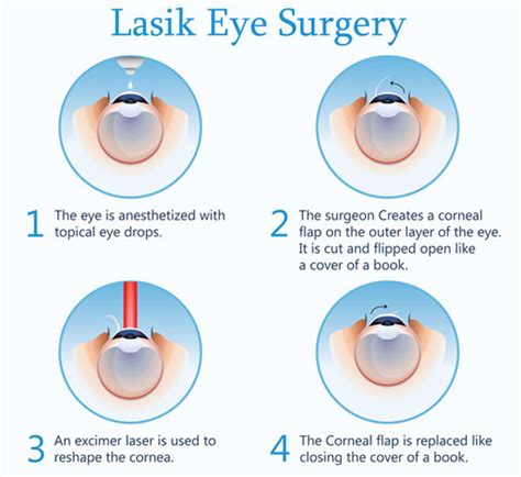 Best Hospital for Lasik Surgery in Bangalore | Best Lasik Eye Surgery ...