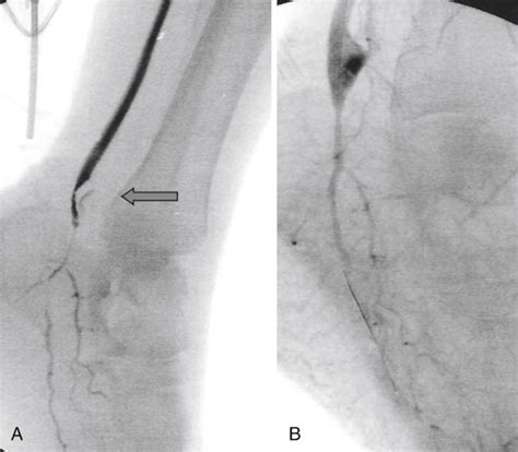 Operative Thrombectomy For Acute Thrombosis Of Lower Extremity Bypass Grafts Thoracic Key