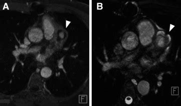 Mycotic Aneurysm Of The Left Anterior Descending Coronary Artery After