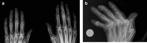 A Early Ra Patient Uniform Joint Space Narrowing Affecting The Download Scientific Diagram