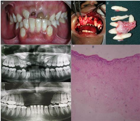 The Preoperative Photograph Showing Mixed Dentition A And The