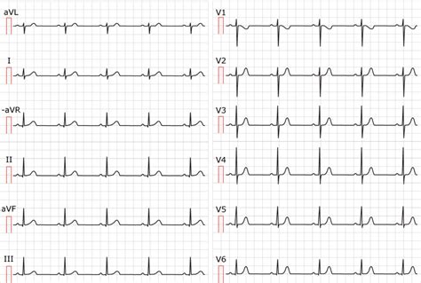 Sinus rhythm: physiology, ECG criteria & clinical implications ...