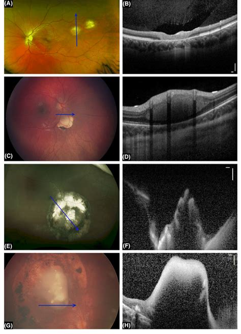 Fundus Picture And Oct Scan Of Patients With Inactive Tumours