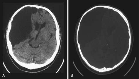 Nontraumatic Brain Emergencies Radiology Key