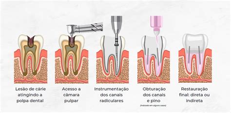 Tratamento De Canal Quando Por Que E Quais Alternativas Existem